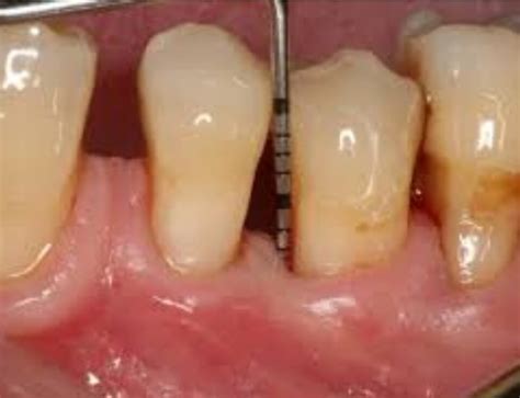 Raspagem Antes E Depois - Raspagem Periodontal Antes E Depois - RETOEDU