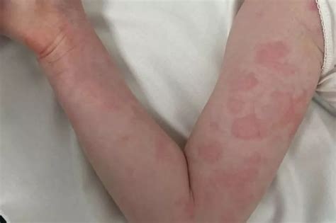 Strep A cases in Yorkshire are highest in the country - YorkshireLive
