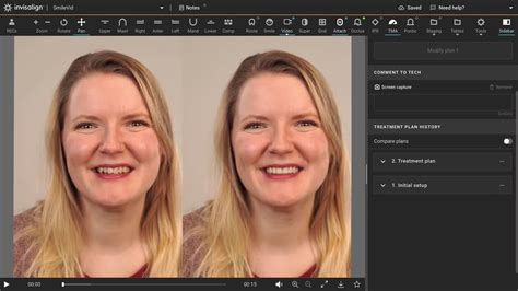 aligntech invisalign itero exocad align technology  comments