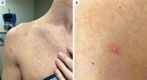 Variola Do Macaco No Inicio - Médica alerta sobre sintomas da varíola dos macacos e a importância da ...