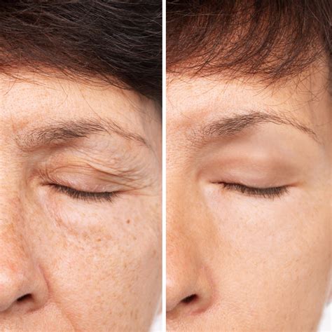 Eyelid Surgery - Blepharoplasty - Santa Rosa