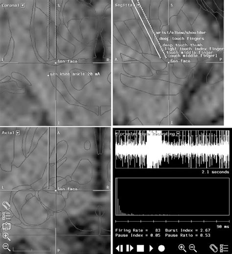 Deep Brain Stimulation for Tremor | Neupsy Key