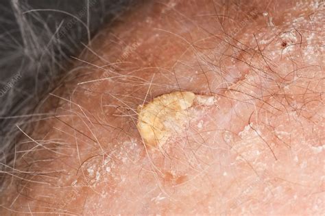 47 HQ Photos Cutaneous Horn Cat Removal - I have an 18 month old Olde ...