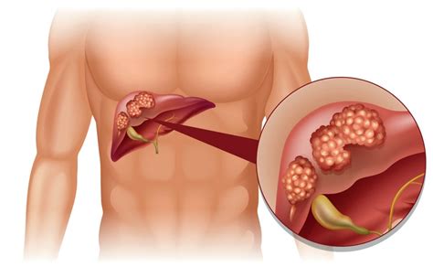 What Is Metastatic Liver Cancer? | MD-Health.com