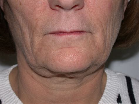 Thermage Before & After Photos | Adoro Medical Spa