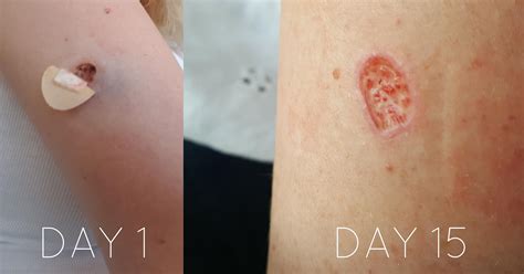Punch Biopsy Healing Images at Michiko Durbin blog
