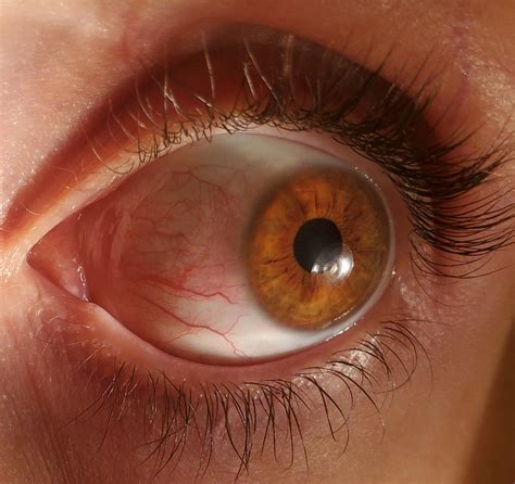 Why Does My Eye Feel Like It's Swelling at Patricia Gatton blog