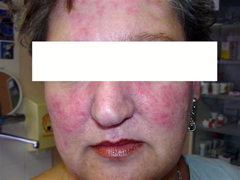 lupus  basic understanding cape jewish chronicle