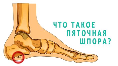 Что такое пяточная шпора и как она лечится? - YouTube