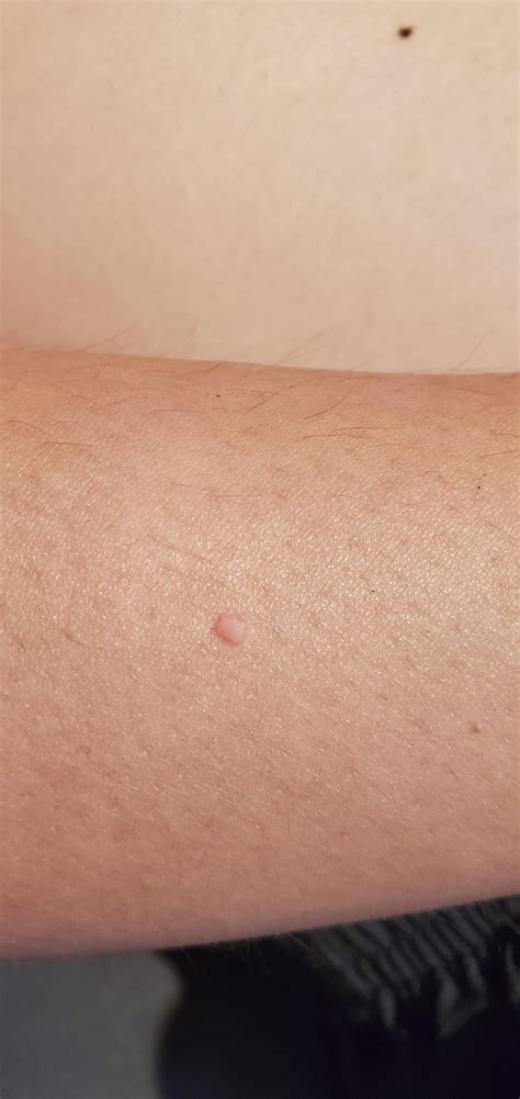 What is this spot on my arm? : r/DermatologyQuestions