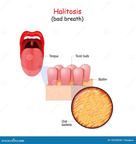 Bad Breath and Bacteria that Cause Halitosis. Human Mouth Stock Vector ...