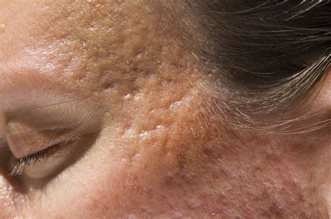Aggressive, early treatment may prevent acne scars