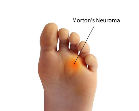 Unpacking Morton's Neuroma