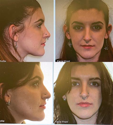 6 months progress! + face change?? : r/braces