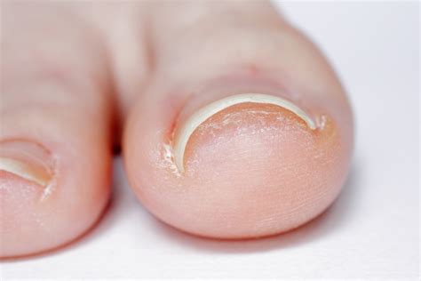 Ingrown Toenails: Navigating Causes & Symptoms - Doral Health & Wellness NY