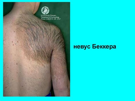 Гирсутизм и гипертрихоз - презентация онлайн