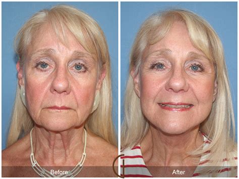 What Is Rhytidectomy? About the Procedure, Benefits, Risks, Cost