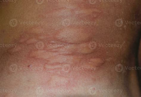 Allergy skin back and sides. Allergic reactions on the skin in the form