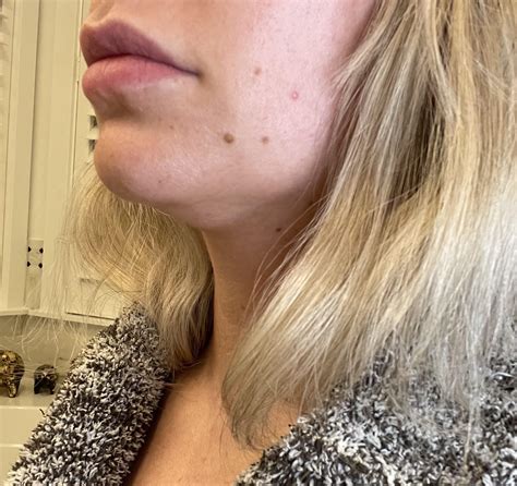 Kybella, chin lipo, jawline fillers, or something else for my double
