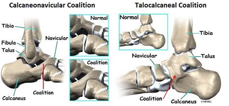 tarsal coalition  symptoms treatment