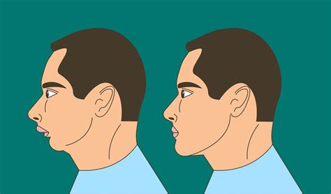 bad overbite profile