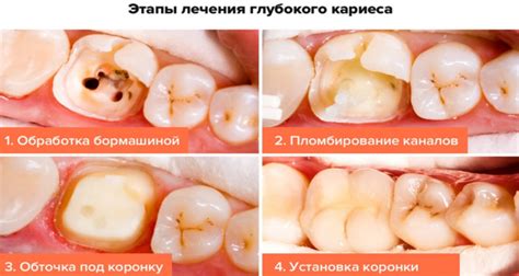 Кариес: описание, виды, лечение и профилактика | Интеллектуальная ...