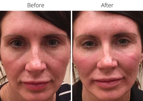 treatments  sunken cheeks melior clinics