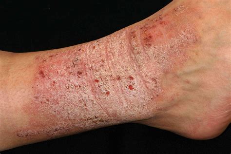 Lichen Sclerosus On Legs