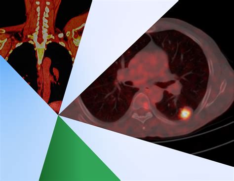 medical imaging cro  oncology clinical trials perceptive