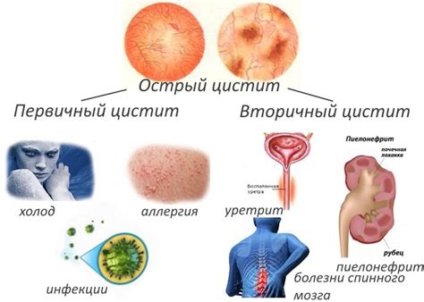 Виды цистита у женщин: классификации, диагностика, лечение