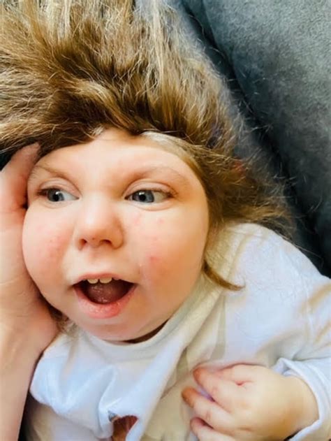 Jaxon Buell, Jaxon Strong, boy born with part of brain missing, dies at 5