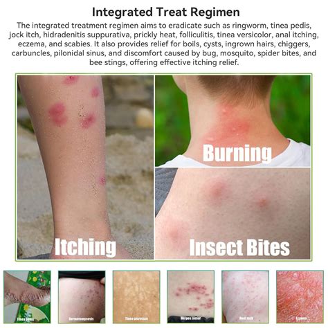 tea tree and eczema 9