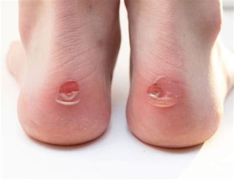 foot blisters wichita podiatrist central kansas podiatry