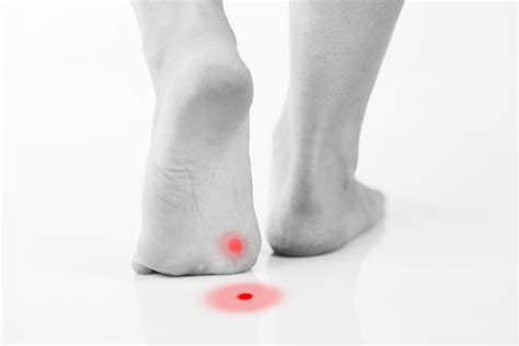 Callus or plantar wart under foot | Daily Health Alerts