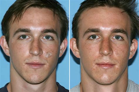 expert rhinoplasty  refining broad nose bridges