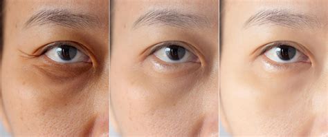 dallas tx  rid  dark circles  eyes plano eye bags treatment