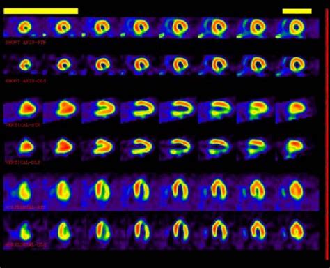 SPECT cardiac images in three positions; short axis, vertical and... | Download Scientific Diagram