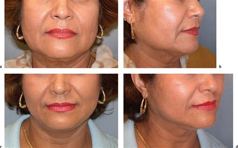 13 Aesthetic Facial Analysis | Plastic Surgery Key