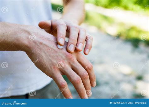 Applying An Emollient To Dry Flaky Skin As In The Treatment Of ...