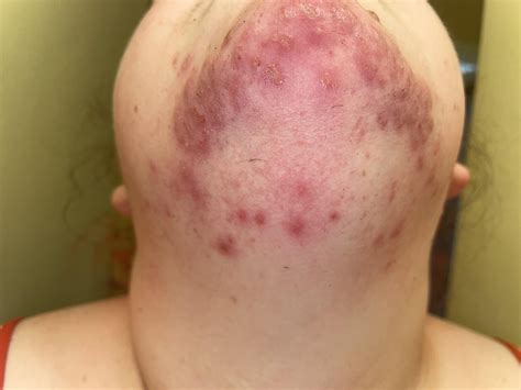 I have fine, coarse facial hairs that grow in and become irritated