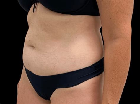 tummy tuck  inspire aesthetics