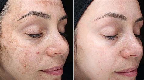 Doe nu ook een Tca Peeling (By Soap) - Taigerclinic.com
