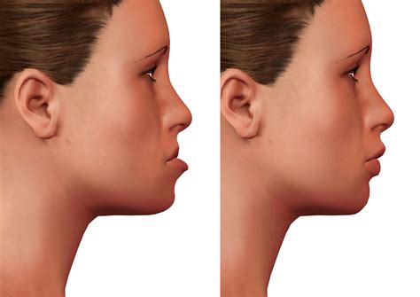 Better Balance With Jaw Surgery | Shirley, NY