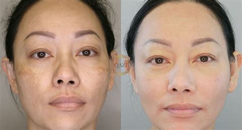 Pico Laser Treatment - Say Goodbye to Skin Imperfections