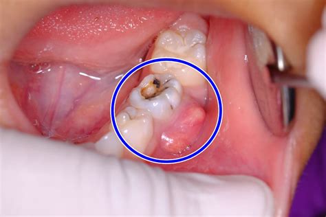 Abscess Tooth Drain