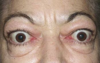 Periorbital Edema Hypothyroidism