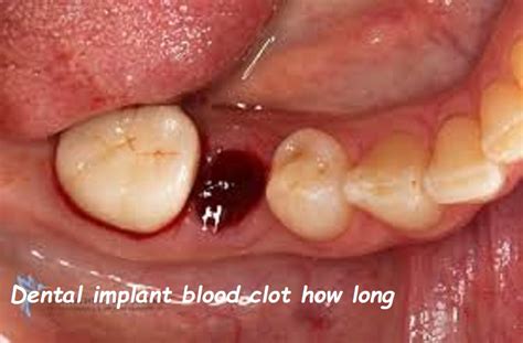 dental implant blood clot  long