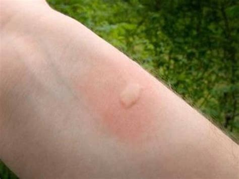 Укус клопа на коже человека: как выглядит, фото, когда прявляются ...