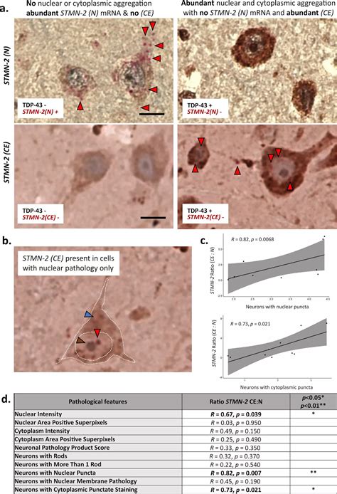 New tool detects signs of motor neuron disease before symptoms begin