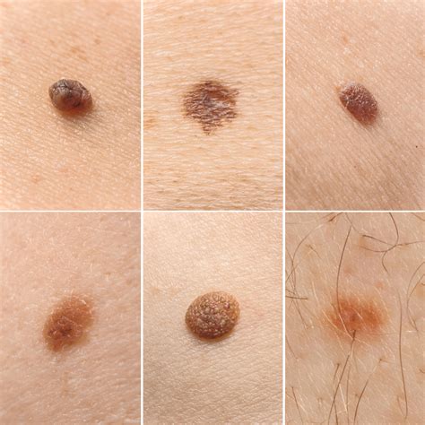 Normal Mole Vs Melanoma